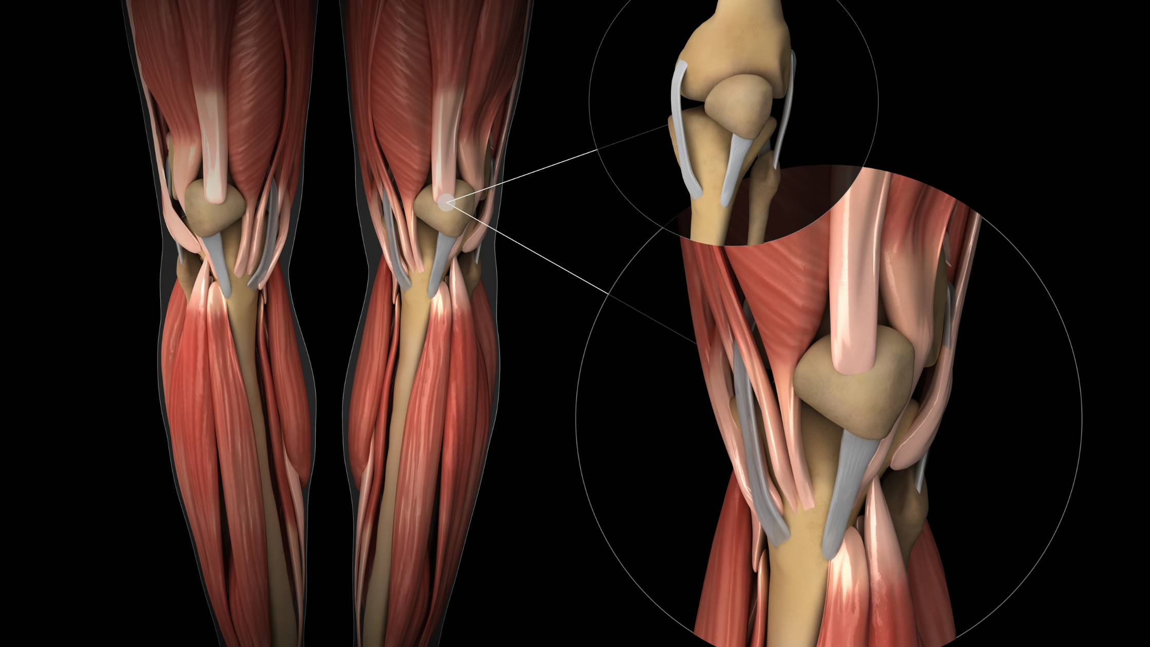 TendoNova for tendon pain
