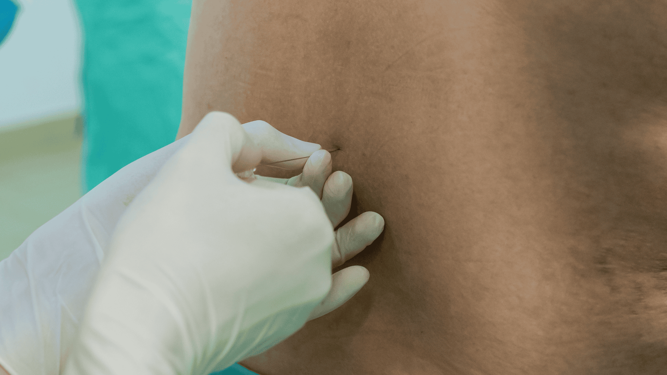 epidural steroid injections