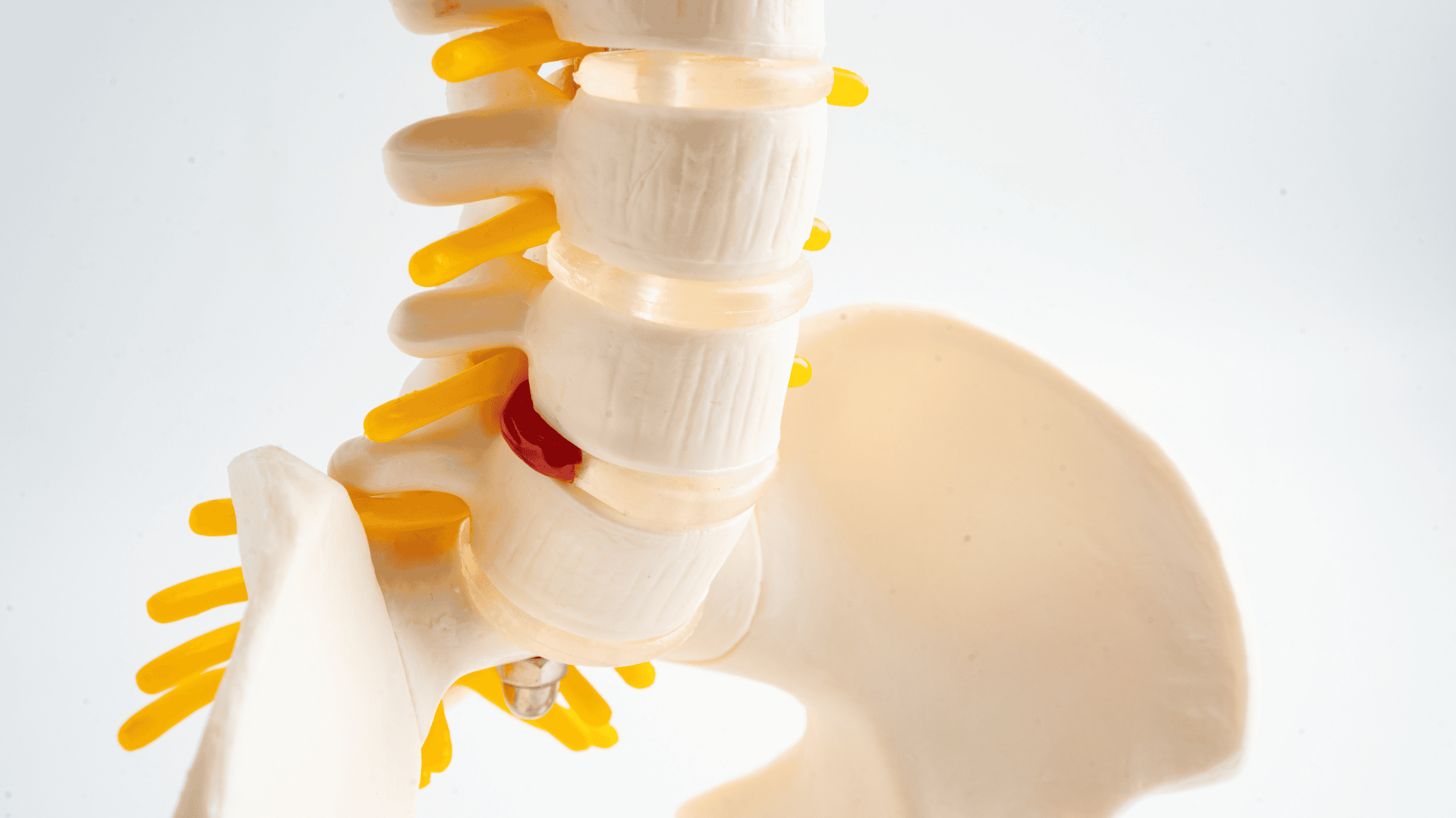 degenerative disc disease